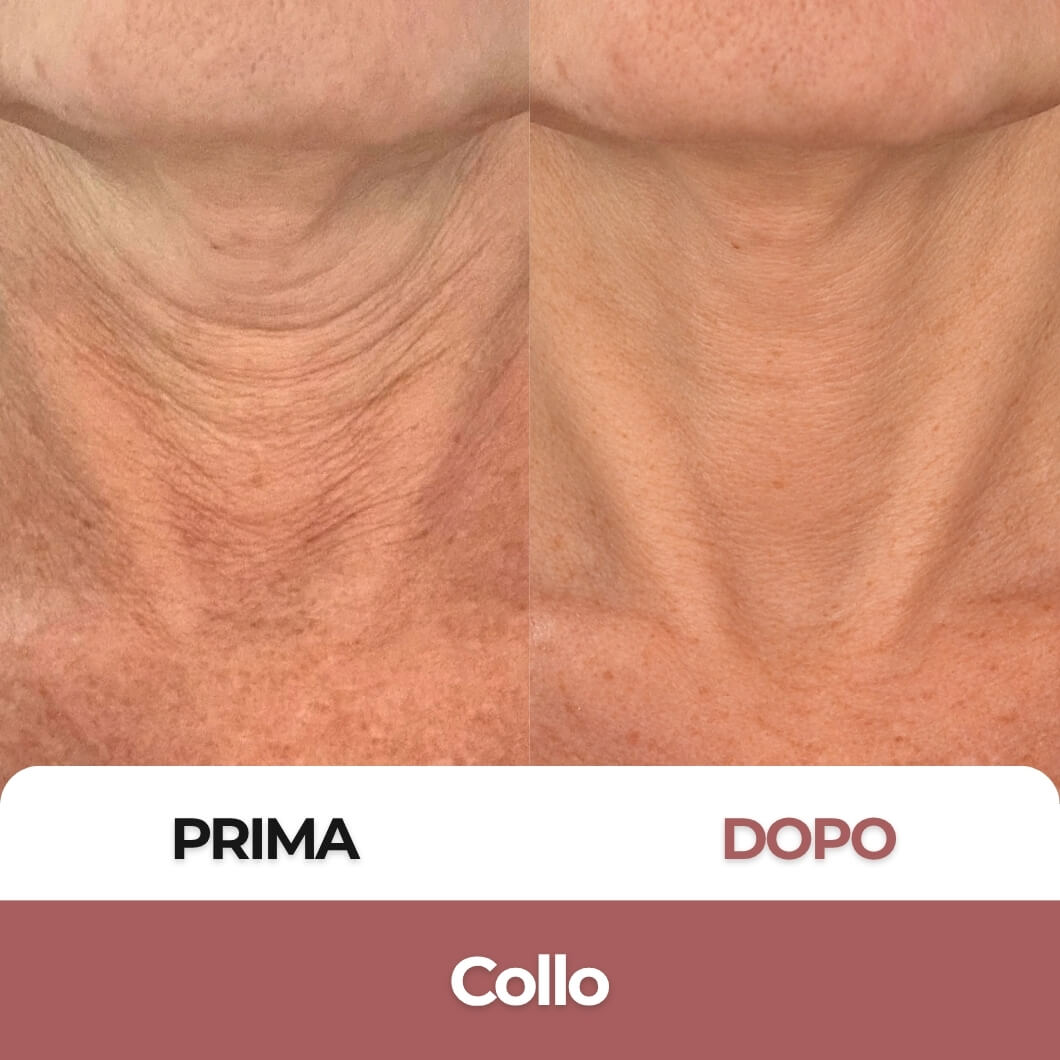 Khelopatra | Kit anti - cedimento 2.0 | Effetto lifting dal primo trattamento